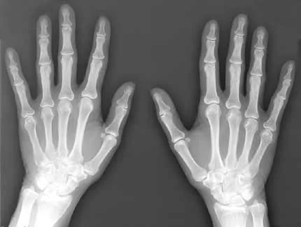 Image courtesy of radiologyinfo.org