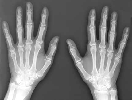 Image courtesy of radiologyinfo.org
