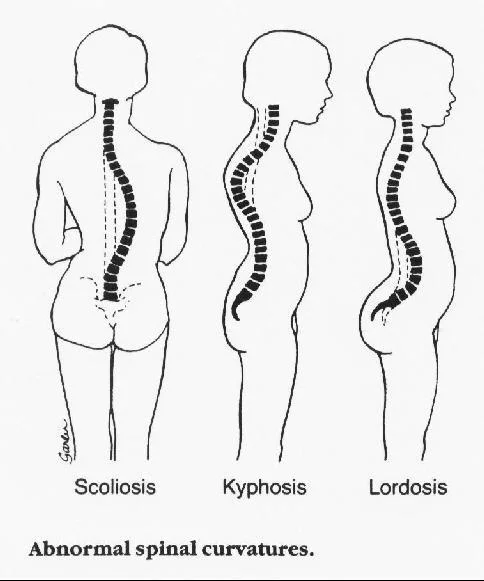 Notice that scoliosis is a lateral curve deviation , whereas the other two examples exaggerate the native curves of the spine.