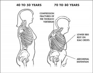 In this extreme example of postural decline (and a dowagers hump), you can see how breathing mechanics would be completely distorted because of postural misalignment. There's no way for the ribs to expand or the diaphragm to move much!