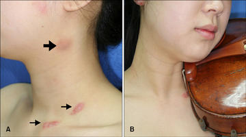 Great picture from Allthingsstrings.com demonstrating a few of the different places where the hickey can manifest, depending on your skin and setup. Some folks just have irritation at the top arrow, others only along the collarbone. It depends on your shoulder rest, chin rest, skin, and setup, for starters, as well as the weather, how much you sweat when you play, and how often you clean the chinrest.