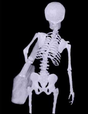 How is your purse/case/messenger bag deforming your body?