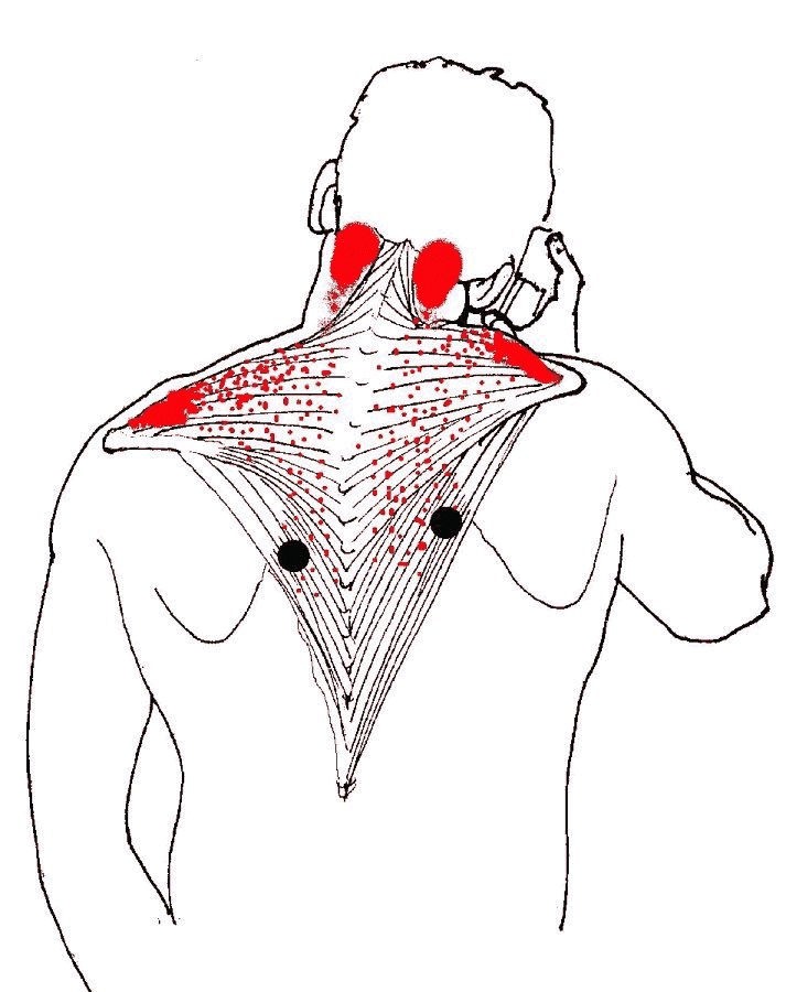 These are some of the most common skeletal trigger points, exacerbated by cell phone usage!