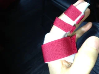 First picture after cast was removed 4/3/13.  Greenish tinge and the pen markings put on pre-op by my surgeon.