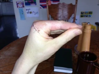 One of the exercise 4/9/13.  Sutures still in place. 