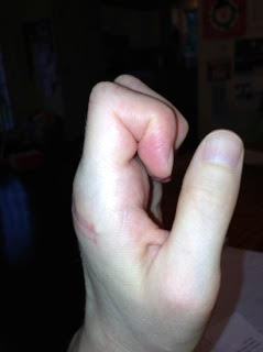 4/28/13 Lots of progress with range of motion and sutures finally out.