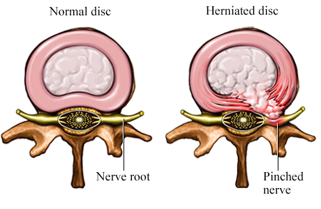 Top view of a disc, with the spinous processes pointing down.