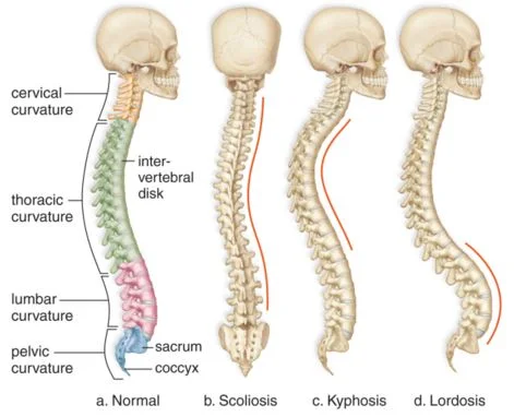 Image from HealthSurgical.com The spine on the left is a "normal" spine, whereas the three on the right show different spinal abnormalities that may occur.