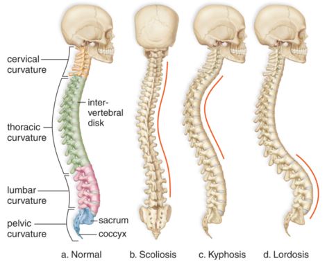 Image from HealthSurgical.com  The spine on the left is a "normal" spine, whereas the three on the right show different spinal abnormalities that may occur.