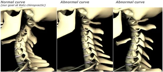 This digitally rendered image from Katz Chiropractic demonstrates three different neck curve variations- "normal," straight, and reverse.