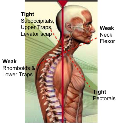 Although this is still a theoretical model, many musicians do have many of these symptoms, including forward head posture, and overly kyphotic/rounded upper spine, and weakness in the back body.
