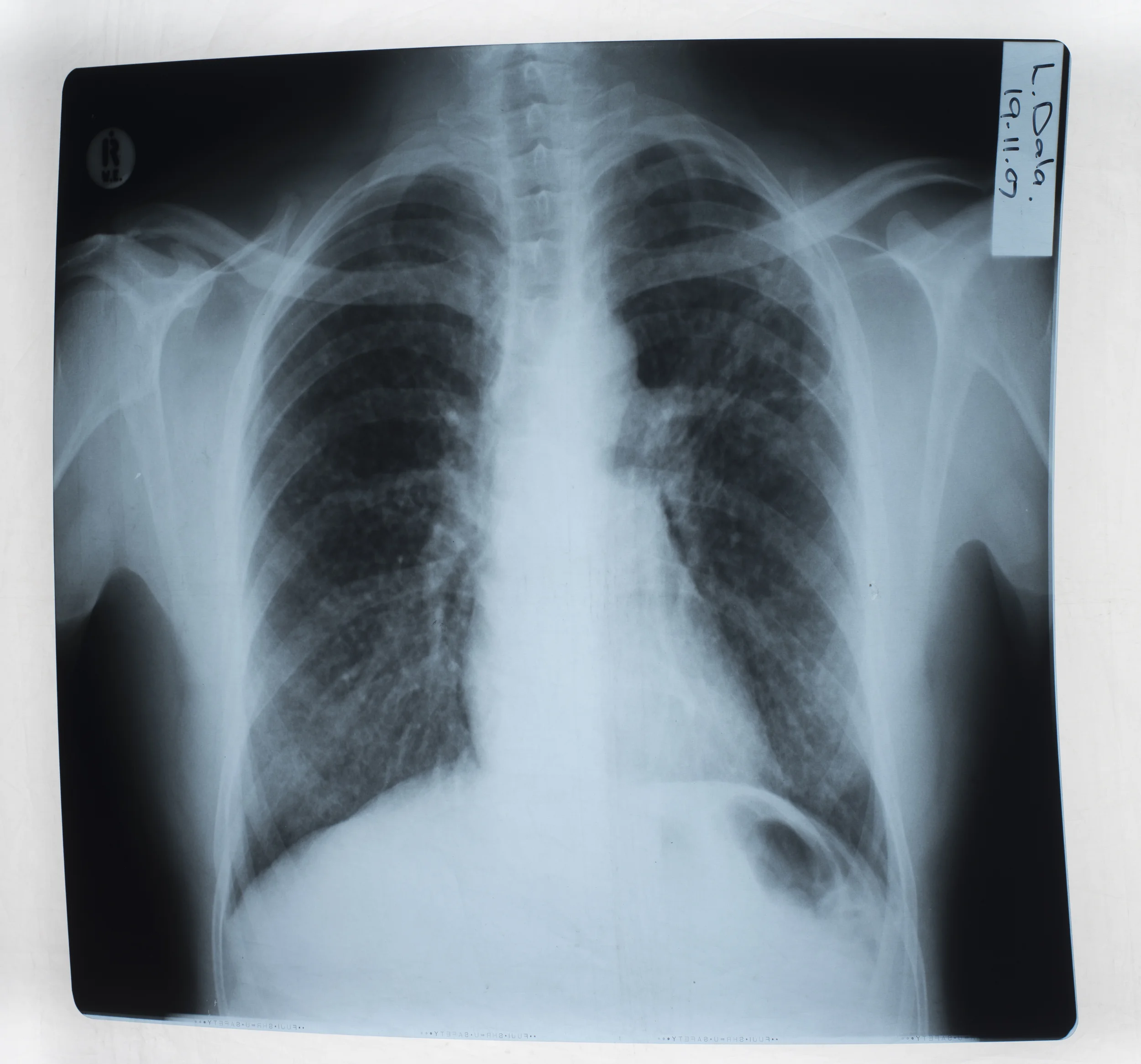 X-Ray of Mr Dala's lungs.