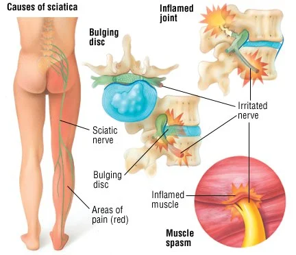 Chiropractic treatment for Sciatica Mandurah