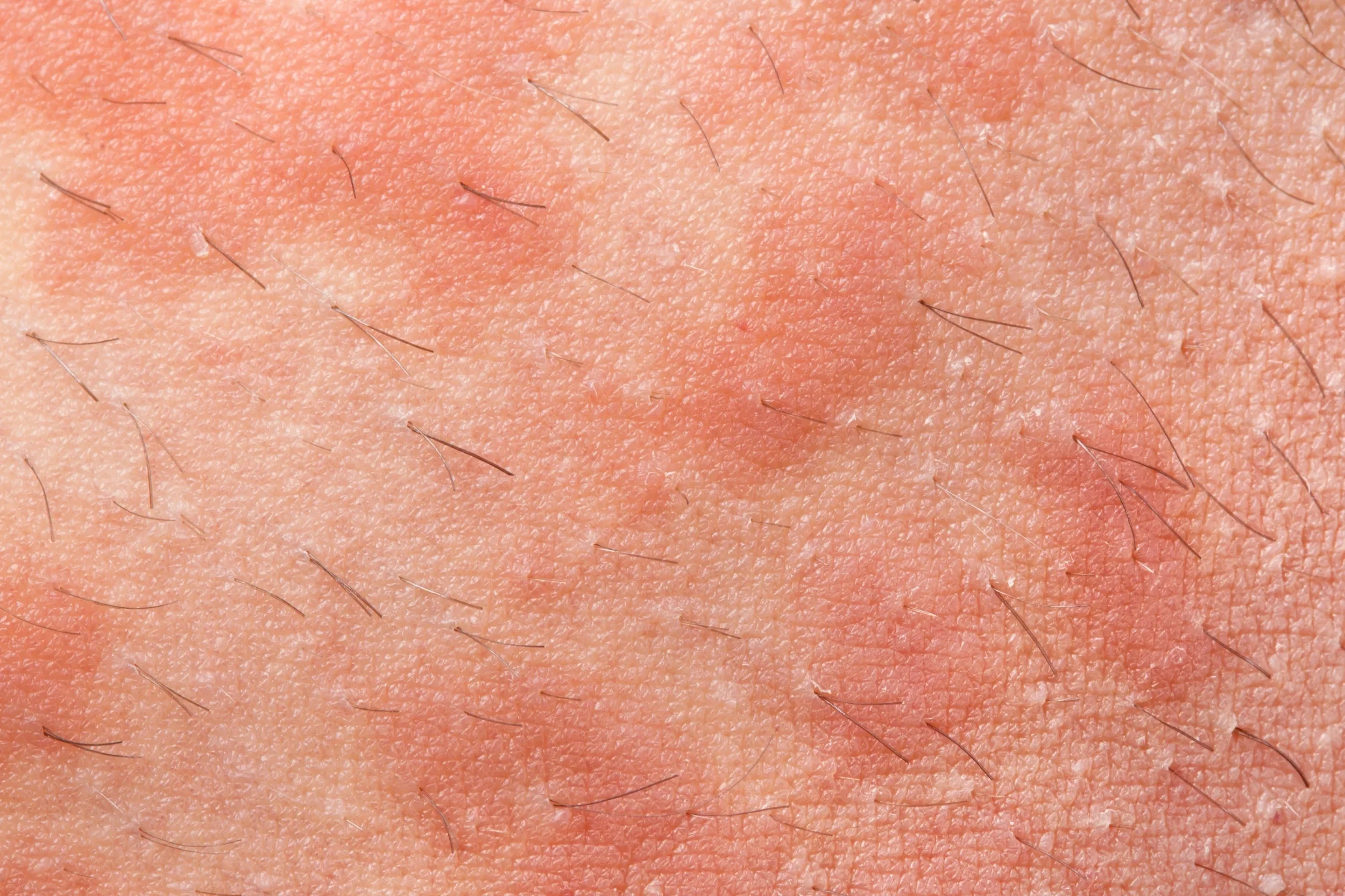 Close-up of inflamed, red, and bumpy skin texture showing a hives or allergic reaction rash.