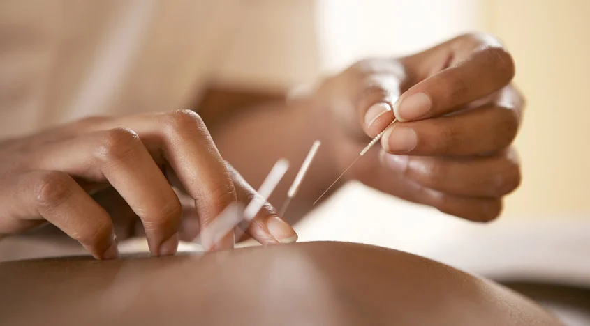 Acupuncture doubles chance of having a baby with IVF, study suggests