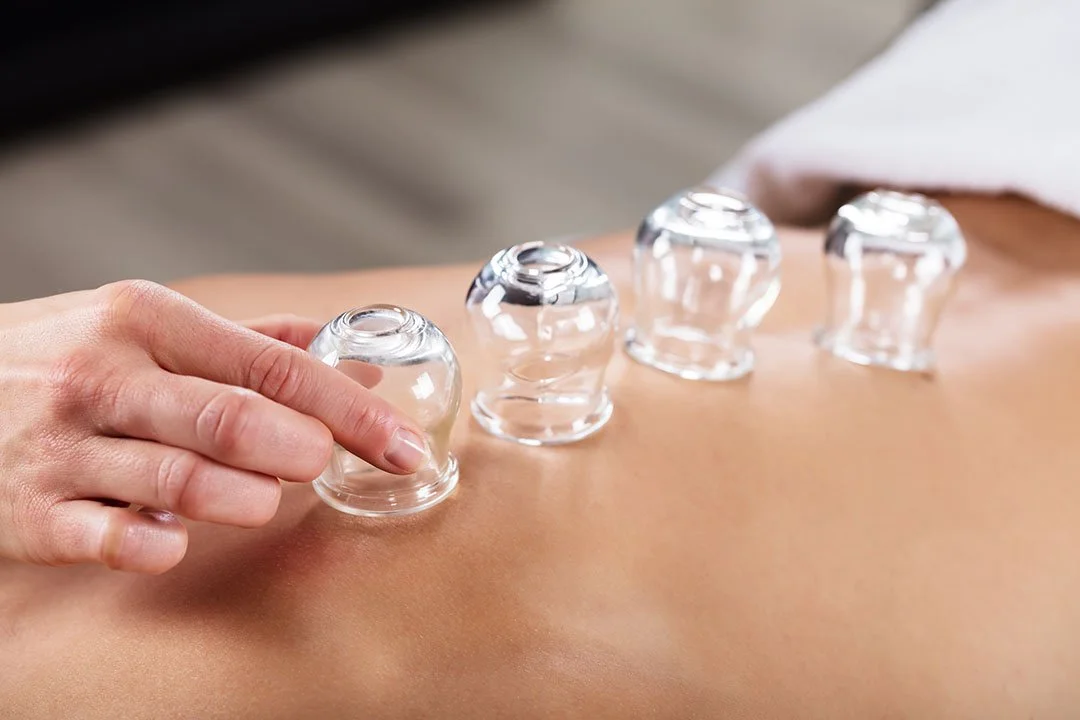 Cupping Therapy: Backed by Research