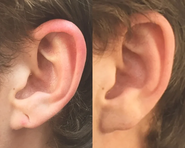 ear before and after.jpg