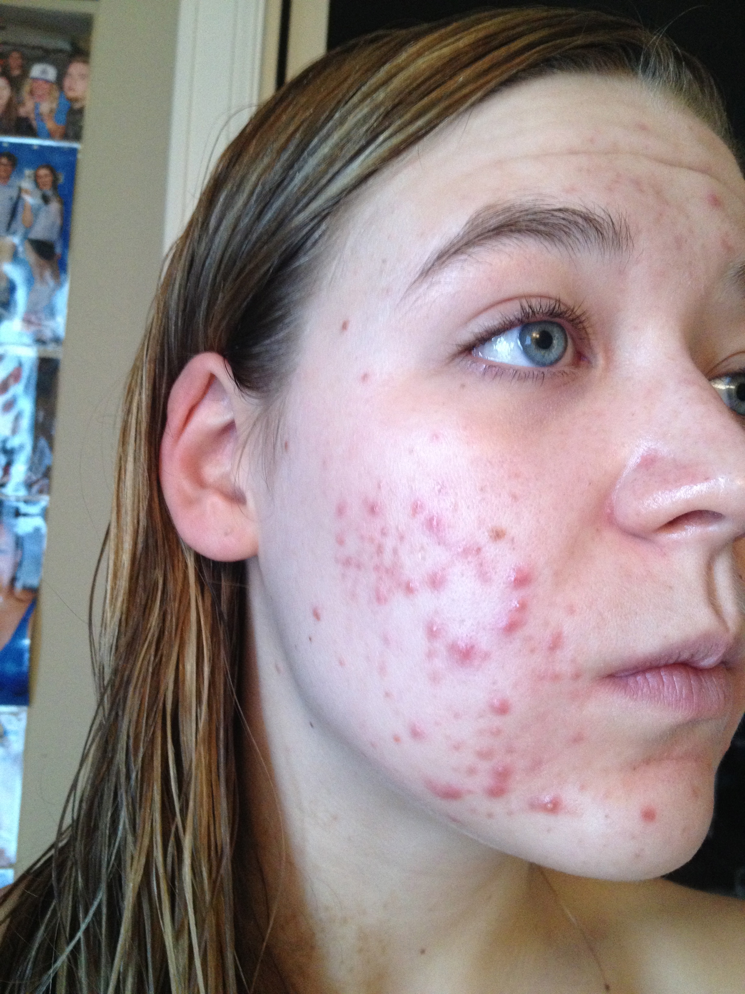 right side. From the day I saw my physician.