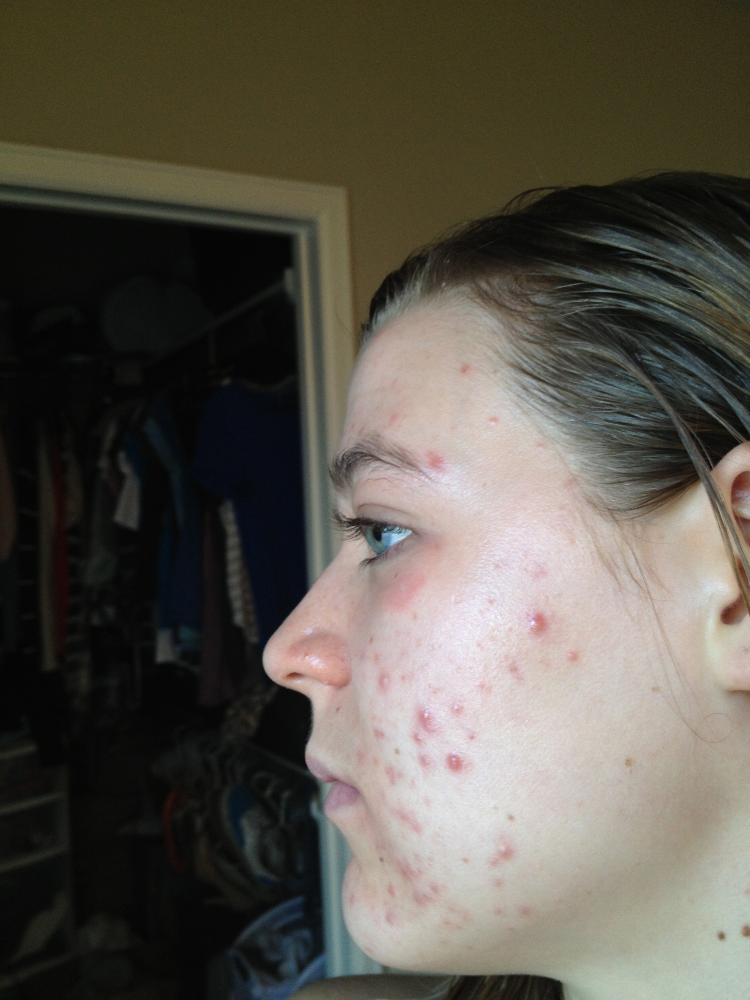left side: my acne at it's worst (April 2013)