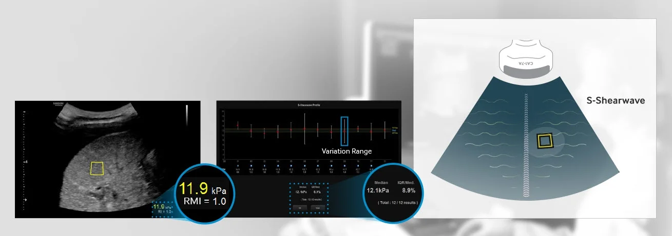 S-Shearwave S-Shearwave detects the velocity of the shear wave propagated through the targeted lesion and displays the numerical measurement of stiffness in kPa or m/s together with a Reliable Measurement Index (RMI).
