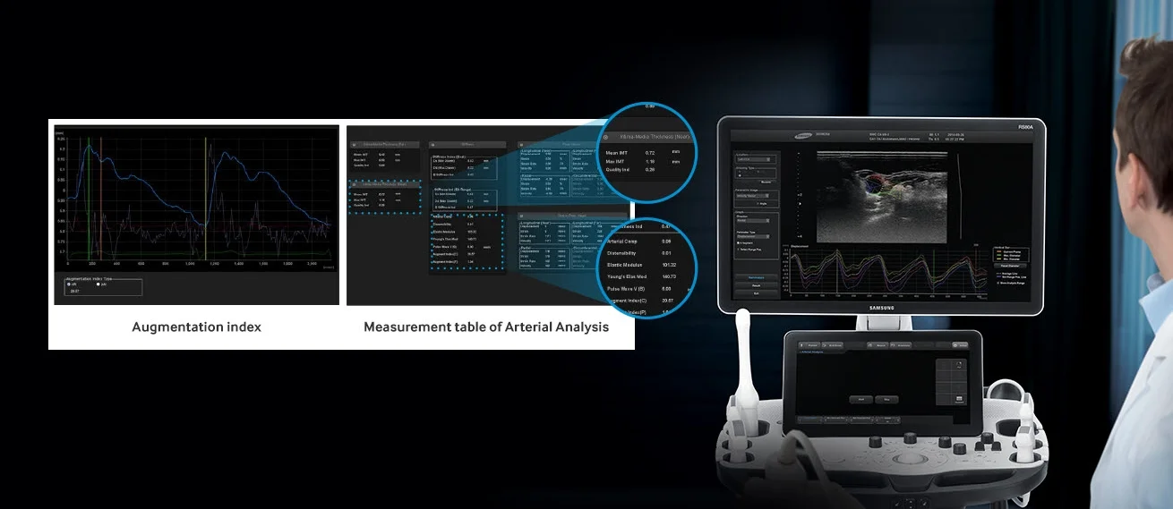 Arterial Analysis (Advanced detection of functional changes of vessels) Arterial Analysis detects functional changes of vessels, providing measurement values such as the stiffness and intra-media thickness.