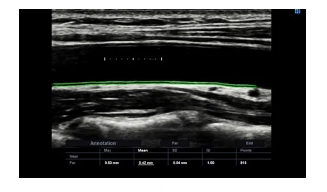 Auto IMT+ Auto IMT+ is a screening tool to analyze a patient's potential risk of stroke and heart disease. It allows easy intramedia thickness measurement of both the anterior and posterior wall of the common carotid by clicking a button.