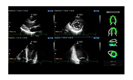 Stress Echo The Stress Echo package includes wall motion scoring and reporting. It includes exercise Stress Echo, pharmacologic Stress Echo, diastolic Stress Echo and free programmable Stress Echo.