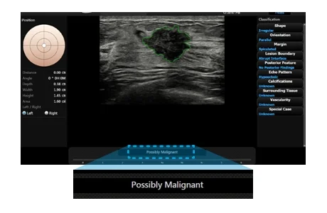 S-Detect for Breast S-Detect employs BI-RADS scores for standardized analysis and classification of suspicious lesions. It provides the characteristics of displayed lesion and recommendation on whether the lesion is malignant by adopting advanced detection algorithms.