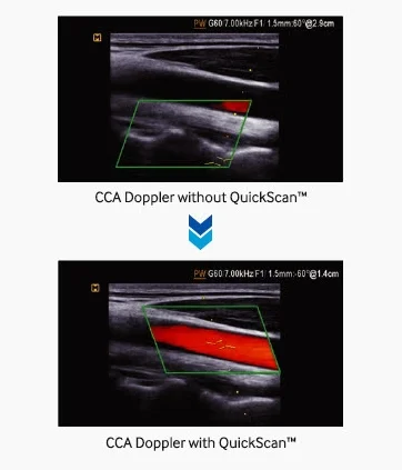 Advanced QuickScan Advanced QuickScan technology provides intuitive optimization of gray scale and Doppler parameters. One touch of the QuickScan button elevates efficiency and workflow by adjusting functions including color gain and color box location.