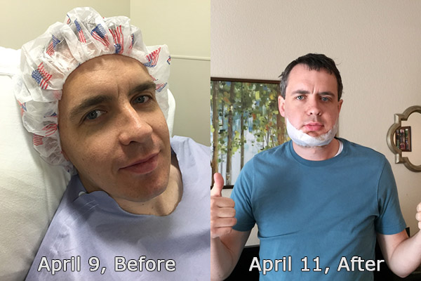 Second 2: Much better — Jaw Surgery Recovery