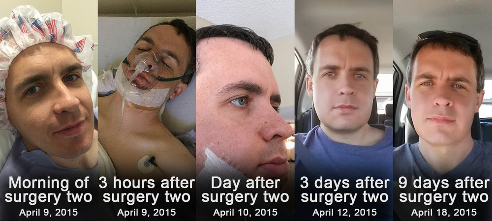 Second Surgery Recovery 10: surgery before and after photos — Jaw Surgery Recovery Tips