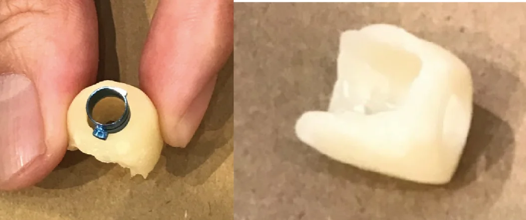 手捏套件無論是在外觀上還是應用上都顯得結構不良和厚度過厚,造成病患的不適