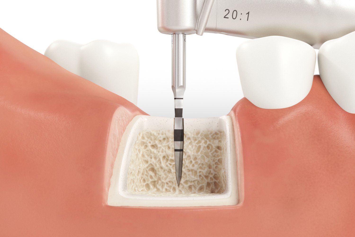 SICmax_Drilling_Guide_Normal_Bone_01_V04.jpg