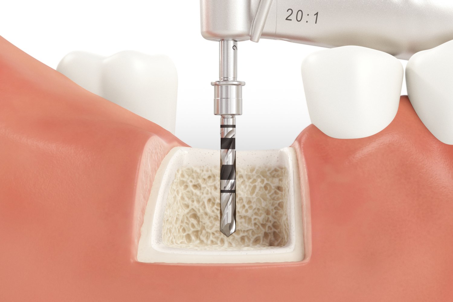 SICmax_Drilling_Guide_Normal_Bone_02_V04.jpg