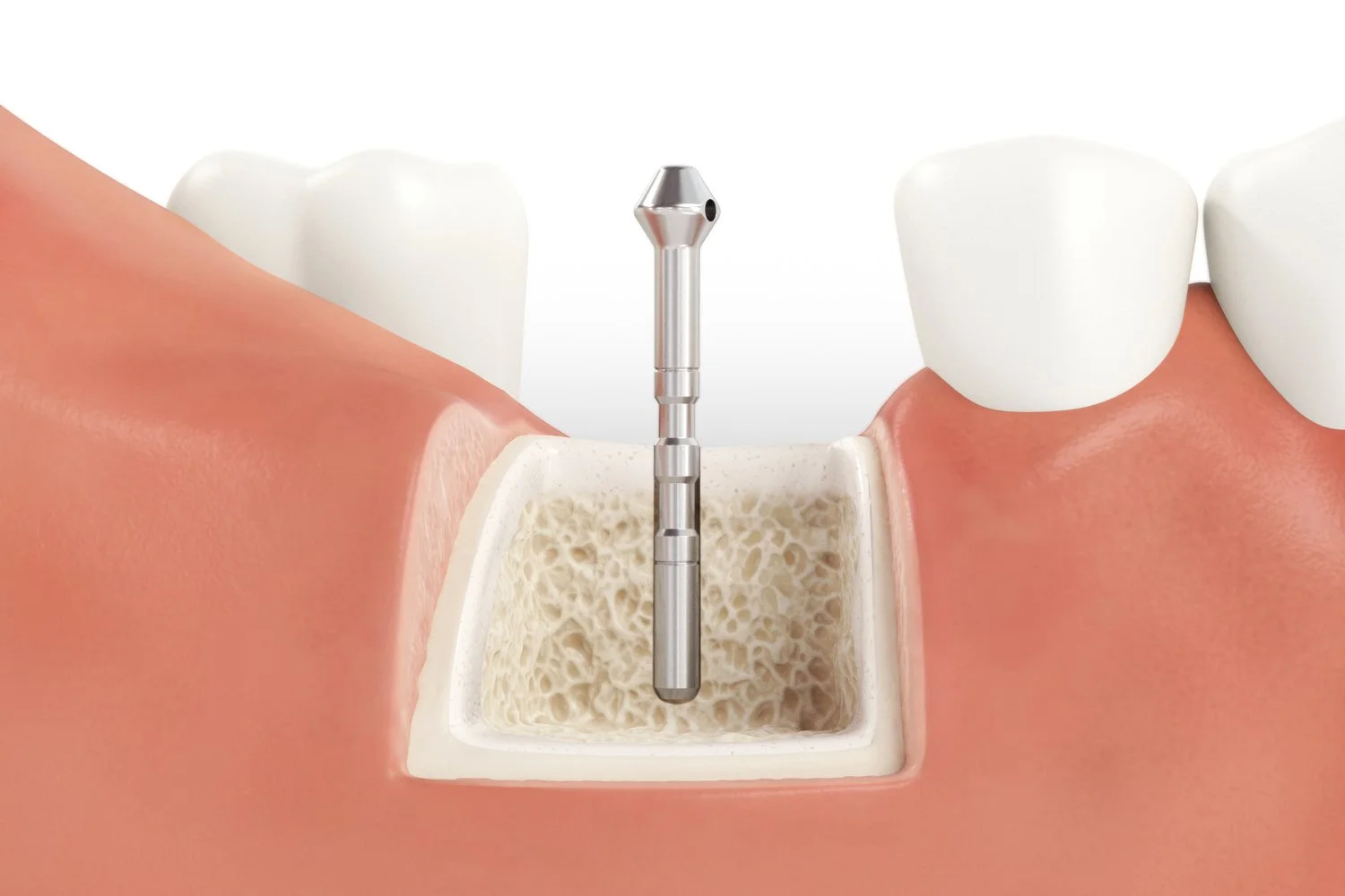 SICmax_Drilling_Guide_Normal_Bone_03_V04.jpg