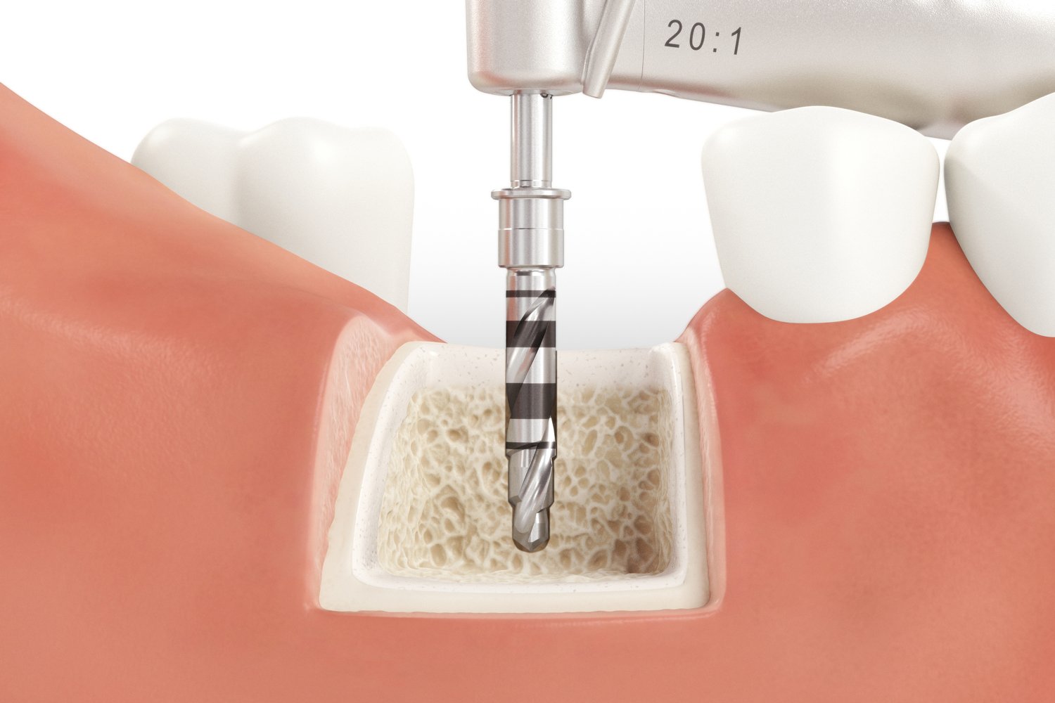 SICmax_Drilling_Guide_Normal_Bone_04_V04.jpg