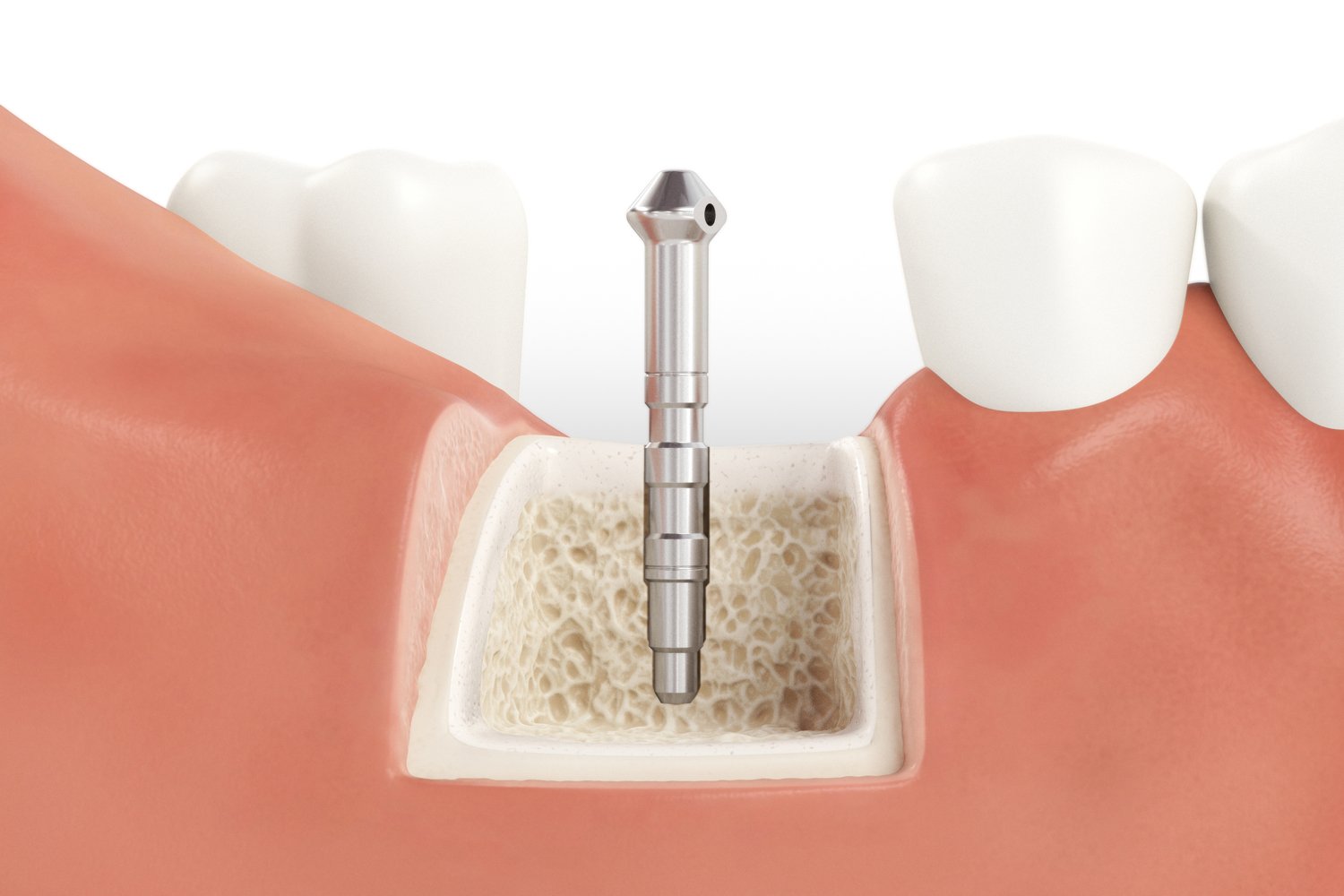 SICmax_Drilling_Guide_Normal_Bone_05_V04.jpg
