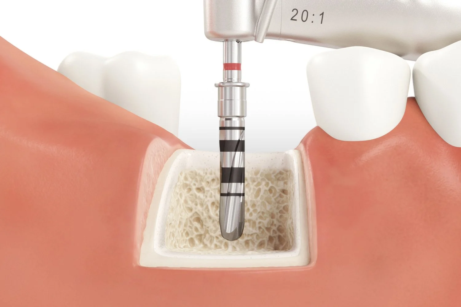 SICmax_Drilling_Guide_Normal_Bone_06_V04.jpg