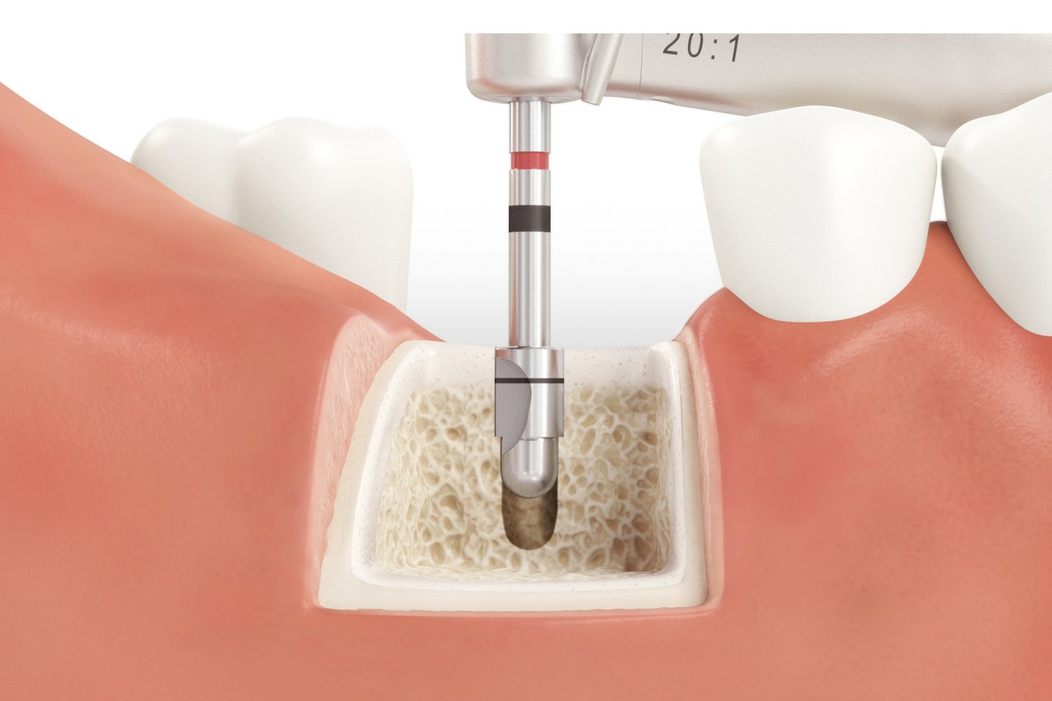 SICmax_Drilling_Guide_Normal_Bone_08_V04.jpg