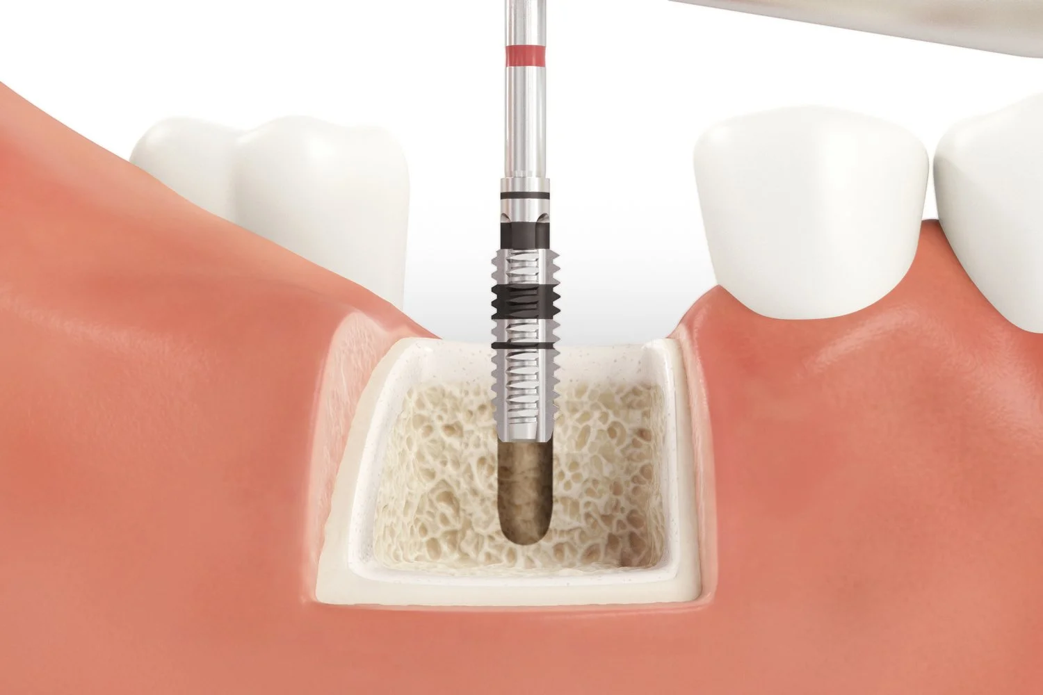 SICmax_Drilling_Guide_Normal_Bone_09_V04.jpg
