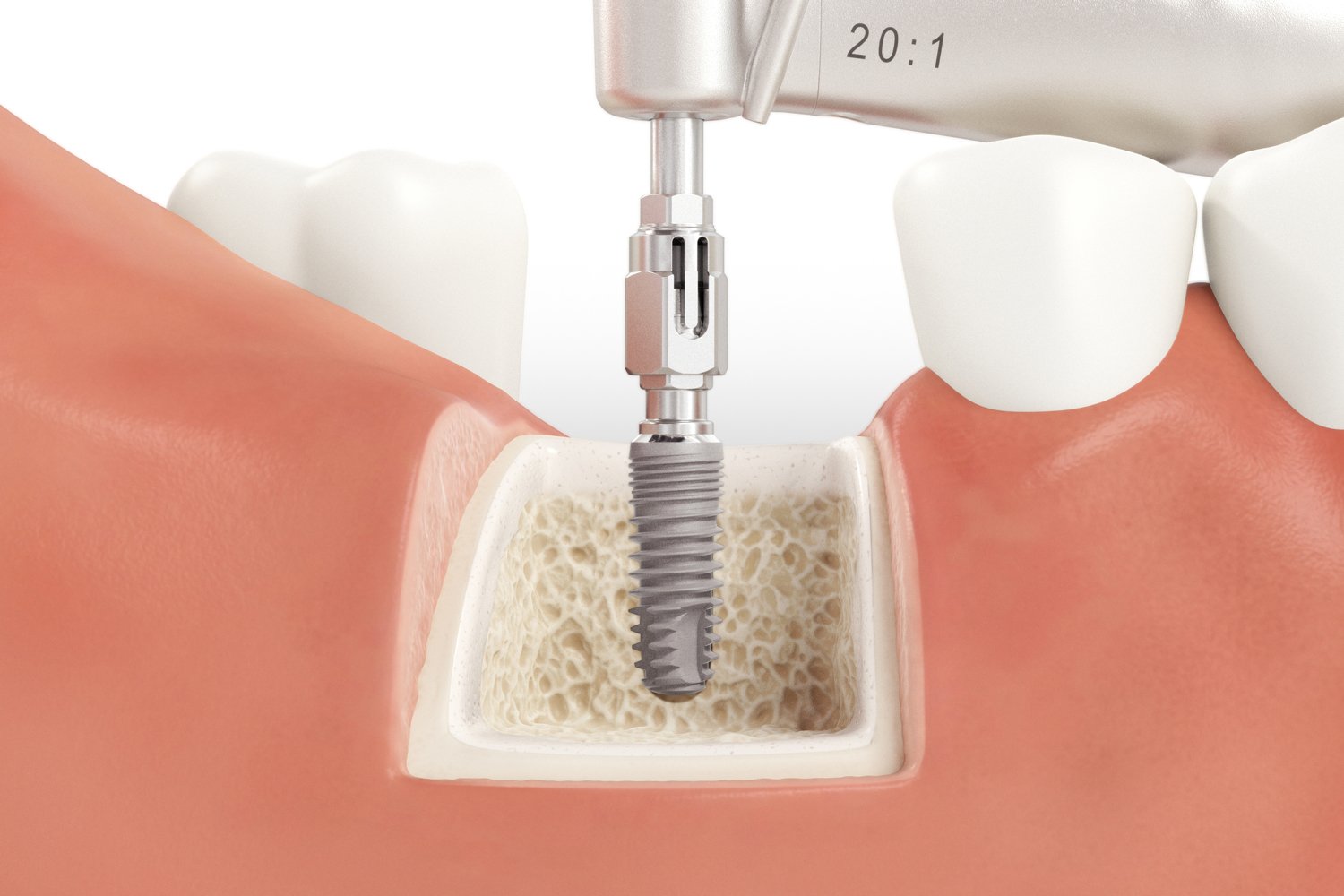 SICmax_Drilling_Guide_Normal_Bone_10_V04.jpg
