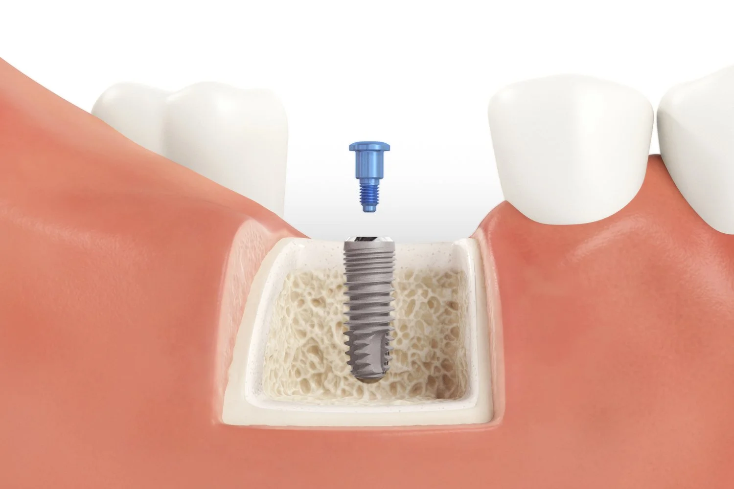 SICmax_Drilling_Guide_Normal_Bone_11_V04.jpg