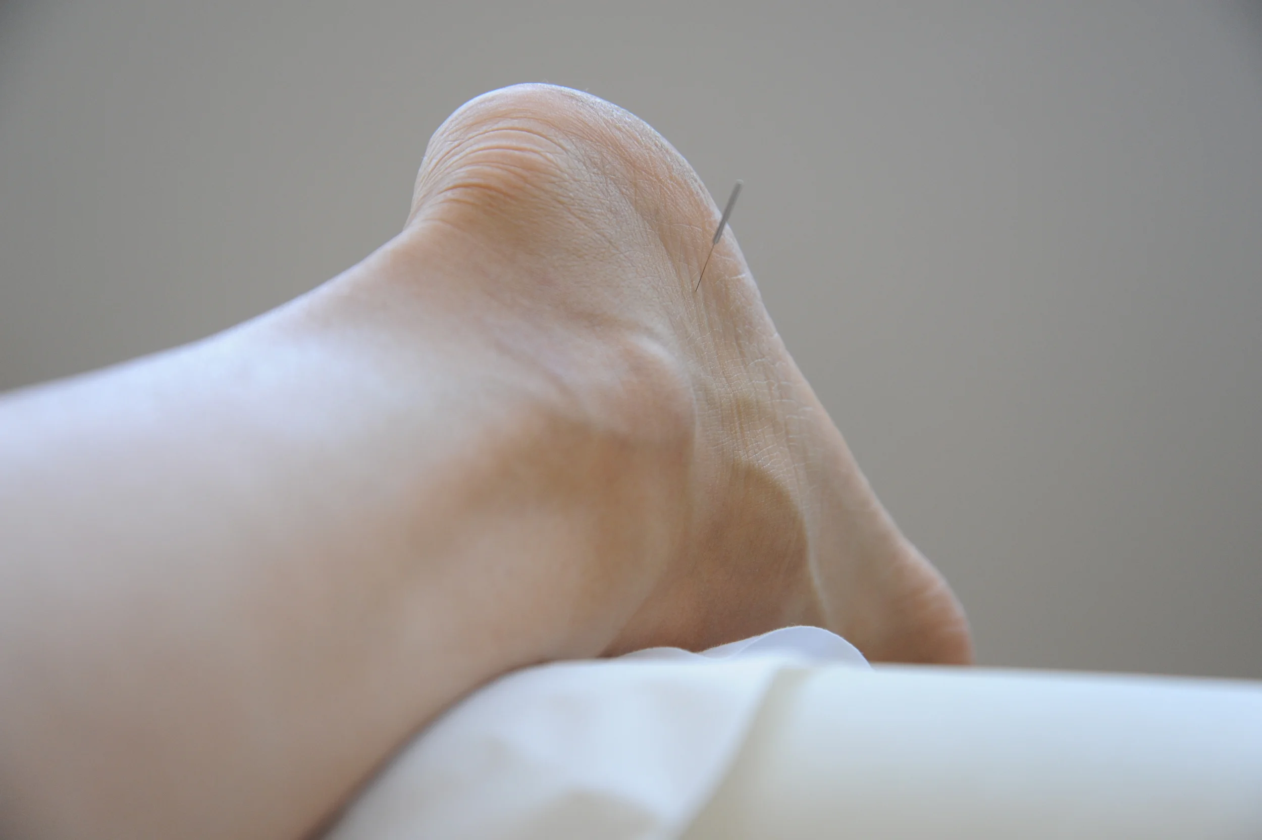Acupuncture For Pain. Photo by Dave Clark. 