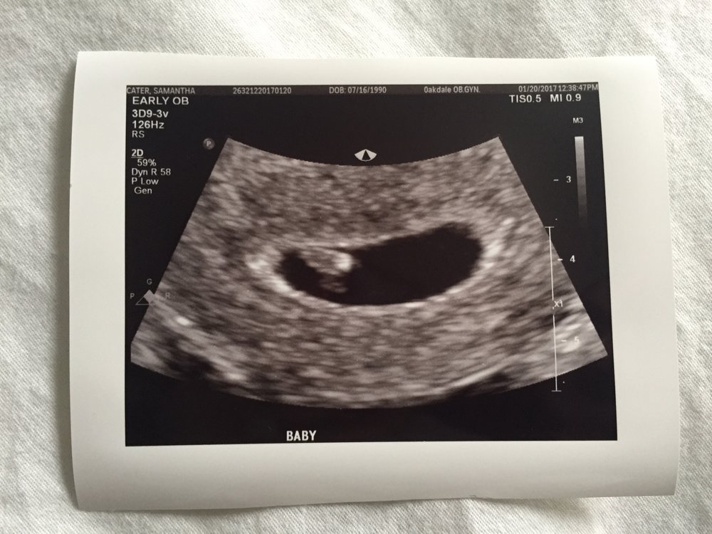 Ultrasound pregnant 8 weeks 8 Weeks