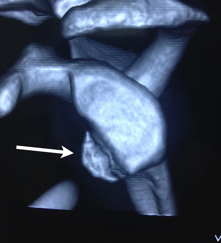 This CT Scan shows a glenoid with the arrow indicating a large bony Bankart lesion.