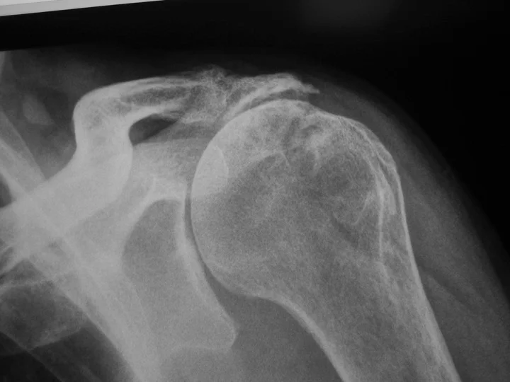 This x-ray shows a massive irreparable cuff tear. You will note the humeral head has subluxed superiorly and is eroding the under-surface of the acromion. The cuff tear is always too large to repair in such cases.