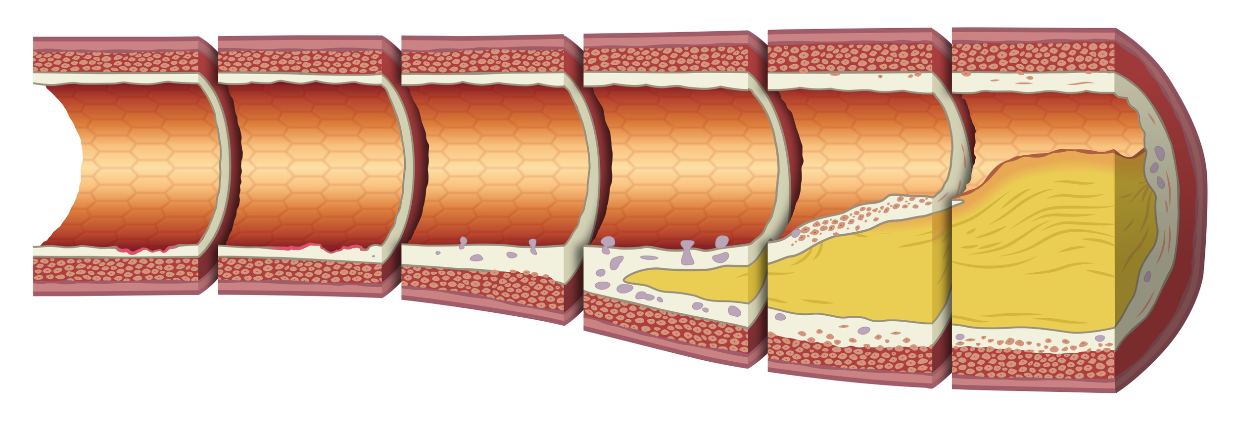 Blocked artery