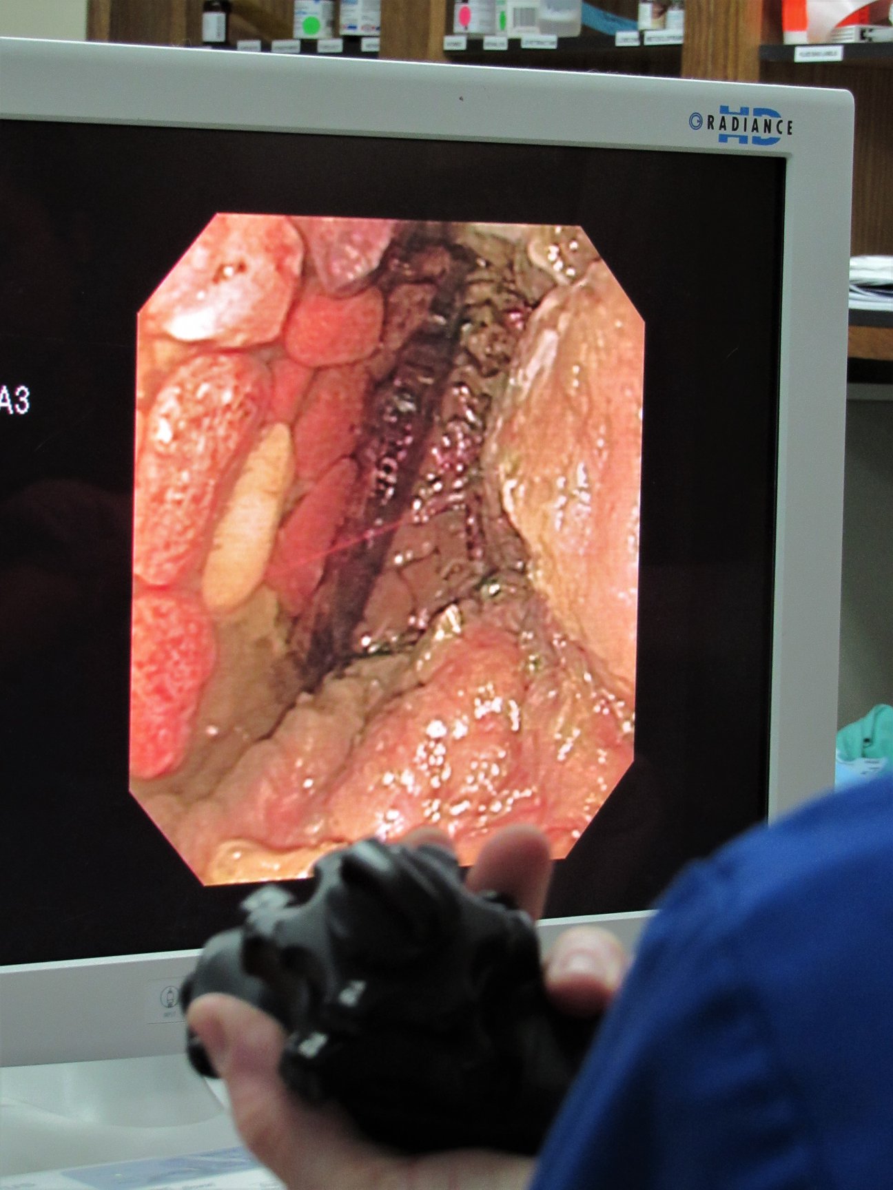 Endoscopic view of the loons gizzard.