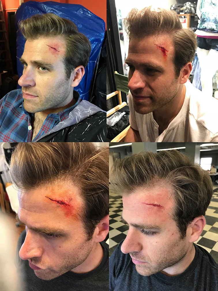Forehead Cut