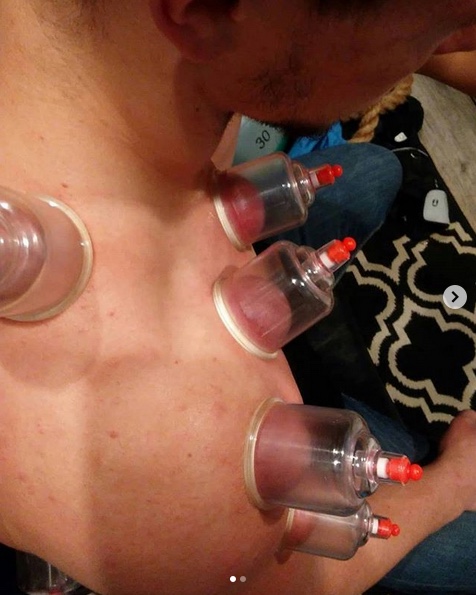 cupping.jpeg